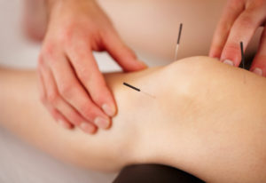 accupuncture-knee-needles-arthritis